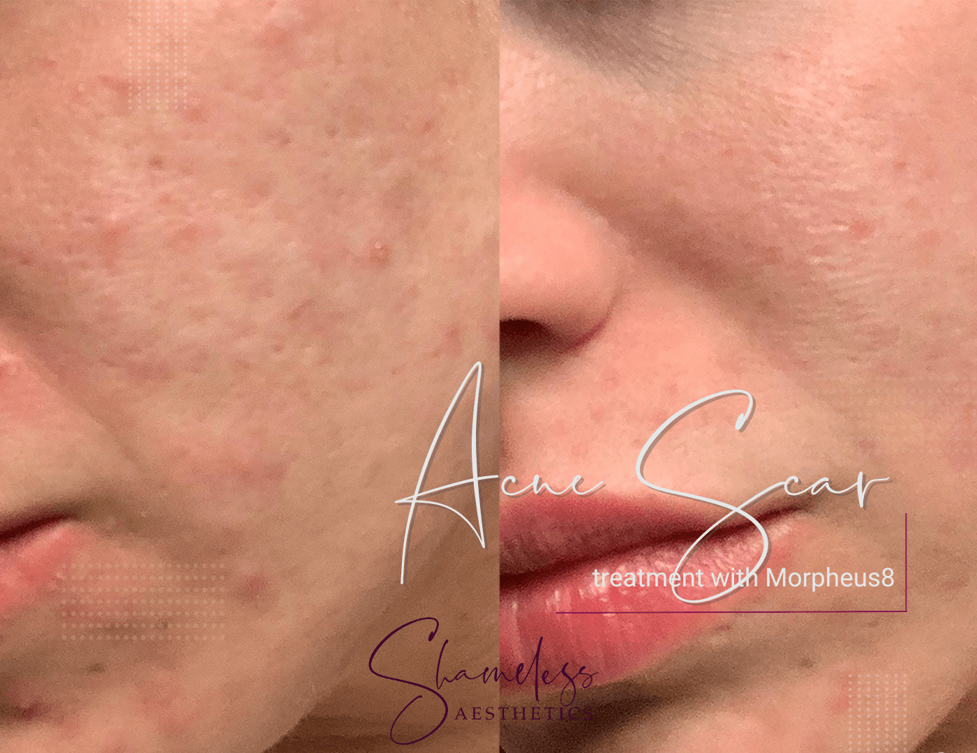 acne scar, acne treatment, acne scar treatment, morpheus 8, rf, radiofrequency, rf microneedling, cumming ga, forsyth county, shameless aesthetics, skin treatment